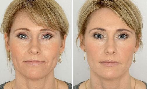 Photos before and after using the cream, experiences with the application Coralift Valerie from Paris