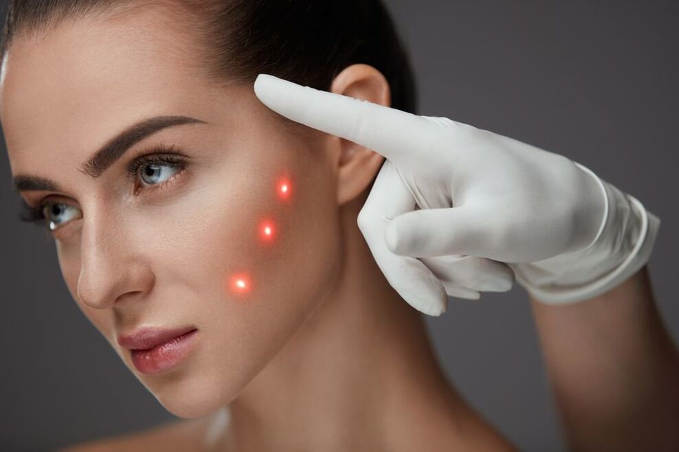 Preparing for laser rejuvenation