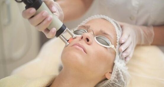 Laser rejuvenation