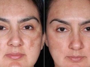 Before and after the rejuvenation procedure